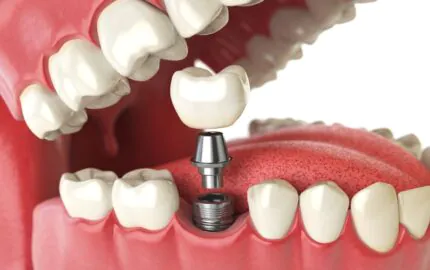 Dental İmplant Tedavisi Nedir