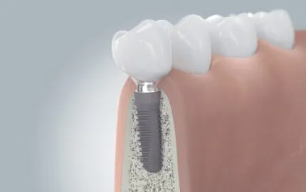 Dental İmplant Hangi Durumlarda Yapılır?