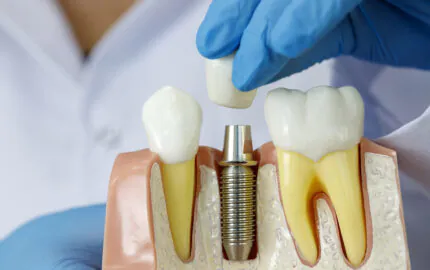 Sağlıklı gülüşler için dental implant tedavisi