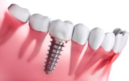 İmplant Aşamaları Nedir