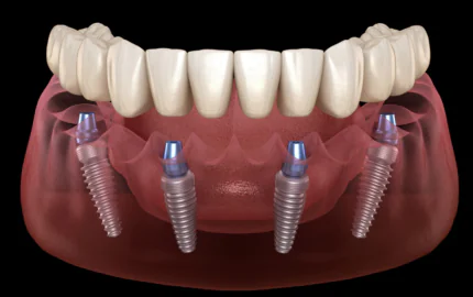 İmplant Tedavileri Sık Sorulan Sorular